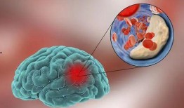 腦梗塞吃瓜尖,天然食療新選擇